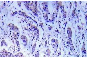 Immunohistochemistry (IHC) analyzes of ASK1 antibody in paraffin-embedded human breast carcinoma tissue. (ASK1 anticorps)