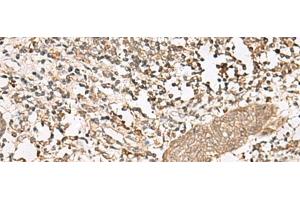 Immunohistochemistry of paraffin-embedded Human esophagus cancer tissue using FGF13 Polyclonal Antibody at dilution of 1:45(x200)