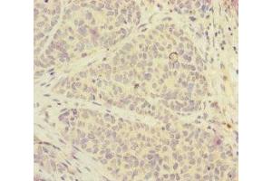 Immunohistochemistry of paraffin-embedded human ovarian cancer using ABIN7152525 at dilution of 1:100 (FOXRED1 anticorps  (AA 307-486))