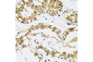 Immunohistochemistry of paraffin-embedded human breast using RPS12 antibody (ABIN5973491) at dilution of 1/100 (40x lens). (RPS12 anticorps)