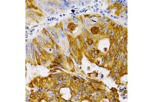 Immunohistochemistry of paraffin-embedded human colon carcinoma using TFF1/pS2 antibody (ABIN3015565, ABIN3015566, ABIN3015567 and ABIN6218896) at dilution of 1:200 (40x lens).