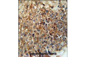 CD46 Antibody immunohistochemistry analysis in formalin fixed and paraffin embedded human hepatocarcinoma followed by peroxidase conjugation of the secondary antibody and DAB staining. (CD46 anticorps  (C-Term))