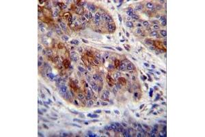 Imunohistochemistry analysis in formalin fixed and paraffin embedded human esophageal carcinoma reacted with HAX1 Antibody (C-term) followed by peroxidase conjugation of the secondary antibody and DAB staining. (HAX1 anticorps  (C-Term))