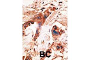 Formalin-fixed and paraffin-embedded human cancer tissue reacted with BMP2K polyclonal antibody  , which was peroxidase-conjugated to the secondary antibody, followed by AEC staining. (BMP2K anticorps  (Internal Region))