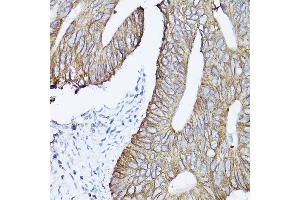 Immunohistochemistry of paraffin-embedded human colon carcinoma using Cytokeratin 19 (Cytokeratin 19 (KRT19)) Rabbit pAb (ABIN3020778, ABIN3020779, ABIN3020780 and ABIN6213719) at dilution of 1:150 (40x lens).