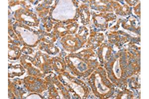 The image on the left is immunohistochemistry of paraffin-embedded Human thyroid cancer tissue using ABIN7130296(MTMR7 Antibody) at dilution 1/40, on the right is treated with fusion protein. (MTMR7 anticorps)