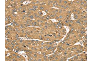 The image on the left is immunohistochemistry of paraffin-embedded Human liver cancer tissue using ABIN7192541(SLIT1 Antibody) at dilution 1/35, on the right is treated with synthetic peptide. (SLIT1 anticorps)