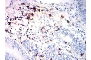 Immunohistochemical analysis of paraffin-embedded endometrial cancer tissues using CD7 mouse mAb with DAB staining. (CD7 anticorps  (AA 26-180))