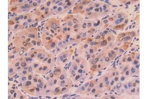 Detection of COL8a1 in Human Liver cancer Tissue using Polyclonal Antibody to Collagen Type VIII Alpha 1 (COL8a1)