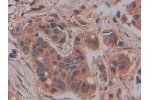 Detection of GSTm4 in Human Breast cancer Tissue using Polyclonal Antibody to Glutathione S Transferase Mu 4 (GSTm4)