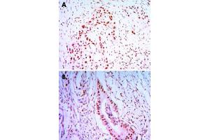 Immunohistochemical analysis of paraffin-embedded human lung cancer tissues (A) and colon cancer tissues (B) using CDC27 monoclonal antibody, clone 5C12  with DAB staining. (CDC27 anticorps)