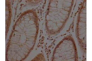 IHC image of ABIN7127368 diluted at 1:500 and staining in paraffin-embedded colon cancer performed on a Leica BondTM system.