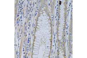 Immunohistochemistry of paraffin-embedded human gastric cancer using MVP Antibody. (MVP anticorps)