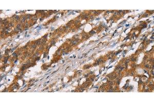 Immunohistochemistry of paraffin-embedded Human gasrtic cancer tissue using DSC2 Polyclonal Antibody at dilution 1:35