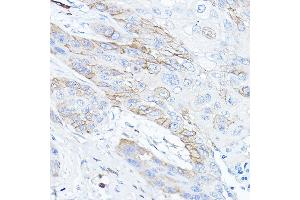 Immunohistochemistry of paraffin-embedded human esophageal cancer using TMPRSS2 Rabbit pAb (ABIN6132728, ABIN6149286, ABIN6149287 and ABIN6219138) at dilution of 1:50 (40x lens). (TMPRSS2 anticorps  (AA 140-400))