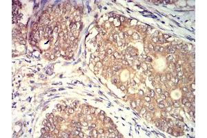 Immunohistochemical analysis of paraffin-embedded cervical cancer tissues using CD140a mouse mAb with DAB staining.