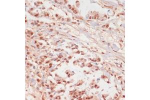 Immunohistochemistry of paraffin-embedded human gastric cancer using Phospho-PPP1CA-T320 antibody (ABIN7269674) at dilution of 1:100 (40x lens).