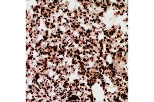 Immunohistochemical analysis of ZNF600 staining in human lung cancer formalin fixed paraffin embedded tissue section. (ZNF600 anticorps)