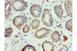Immunohistochemistry of paraffin-embedded human breast cancer using ABIN7151101 at dilution of 1:100 (Pellino 1 anticorps  (AA 1-250))