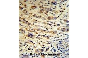 A1BG Antibody (C-term) (R) IHC analysis in formalin fixed and paraffin embedded human breast carcinoma tissue followed by peroxidase conjugation of the secondary antibody and DAB staining. (A1BG anticorps  (C-Term))