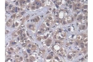DAB staining on IHC-P; Samples: Human Breast cancer Tissue (CPEB1 anticorps  (AA 311-561))