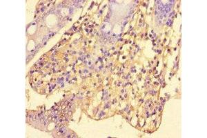 Immunohistochemistry of paraffin-embedded human colon cancer using ABIN7169823 at dilution of 1:100