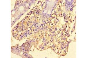 Immunohistochemistry of paraffin-embedded human colon cancer using ABIN7169823 at dilution of 1:100 (SLIT-ROBO rho GTPase Activating Protein 2C (SRGAP2C) (AA 1-242) anticorps)