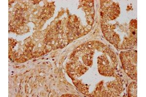 IHC image of ABIN7166823 diluted at 1:200 and staining in paraffin-embedded human prostate cancer performed on a Leica BondTM system. (C14ORF177 anticorps  (AA 1-125))