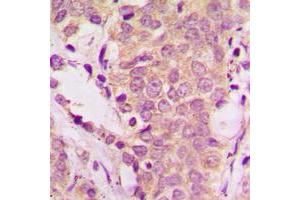 Immunohistochemical analysis of SHCA (pY349) staining in human prostate cancer formalin fixed paraffin embedded tissue section.