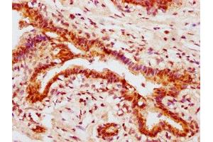 IHC image of ABIN7127677 diluted at 1:100 and staining in paraffin-embedded human breast cancer performed on a Leica BondTM system. (Recombinant AKT1 anticorps  (pSer473))