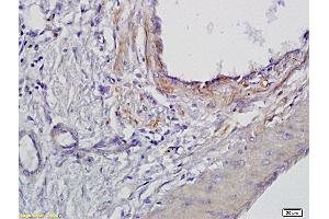 Formalin-fixed and paraffin embedded human gastric cancer labeled with Anti BMAL1 Polyclonal Antibody, Unconjugated (ABIN703571) at 1:300 followed by conjugation to the secondary antibody and DAB staining (ARNTL anticorps  (AA 151-250))