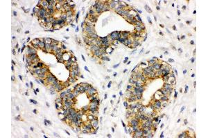 Anti- ITGA2B Picoband antibody, IHC(P) IHC(P): Human Mammary Cancer Tissue