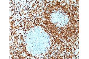 FFPE non-Hodgkin's lymphoma stained with Bcl2 antibody cocktail. (Bcl-2 anticorps  (AA 41-54))