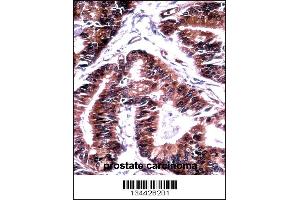 TCEB1 Antibody immunohistochemistry analysis in formalin fixed and paraffin embedded human prostate carcinoma followed by peroxidase conjugation of the secondary antibody and DAB staining.