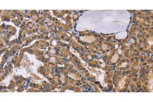 Immunohistochemistry of paraffin-embedded Human thyroid cancer tissue using EPHB6 Polyclonal Antibody at dilution 1:50 (EPH Receptor B6 anticorps)