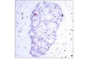 Immunohistochemical analysis of paraffin-embedded human breast carcinoma tissue using NF-κ,B p105(phospho-Ser907) antibody.