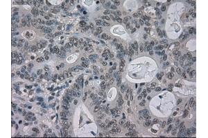 Immunohistochemical staining of paraffin-embedded Carcinoma of liver tissue using anti-BUB1Bmouse monoclonal antibody. (BUB1B anticorps)