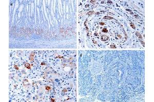 Immunohistochemical analysis of EPHB1 in human gastric cancer tissues. (EPH Receptor B1 anticorps  (C-Term))