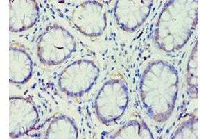 Immunohistochemistry of paraffin-embedded human colon cancer using ABIN7167947 at dilution of 1:100 (GRAF anticorps  (AA 625-814))