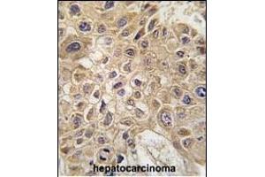 Formalin-fixed and paraffin-embedded human hepatocarcinoma tissue reacted with FR Antibody (C-term) (ABIN388938 and ABIN2850529) , which was peroxidase-conjugated to the secondary antibody, followed by DAB staining. (AMFR anticorps  (AA 571-601))