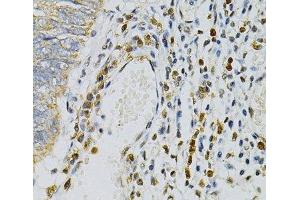 Immunohistochemistry of paraffin-embedded Human colon carcinoma using CDA Polyclonal Antibody at dilution of 1:100 (40x lens). (CDA anticorps)