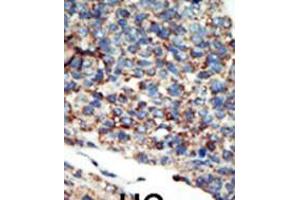 Formalin-fixed and paraffin-embedded human cancer tissue reacted with the primary antibody, which was peroxidase-conjugated to the secondary antibody, followed by AEC staining. (PI3KC2G anticorps  (N-Term))
