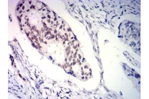 Immunohistochemical analysis of paraffin-embedded rectal cancer tissues using PGR mouse mAb with DAB staining. (Progesterone Receptor anticorps  (AA 166-411))