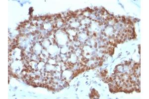Formalin-fixed, paraffin-embedded human Gastric Carcinoma stained with ER-beta1 Mouse Monoclonal Antibody (ERb455). (ESR2 anticorps  (C-Term))