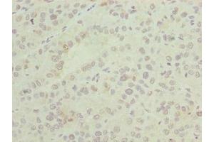 Immunohistochemistry of paraffin-embedded human liver cancer using ABIN7144721 at dilution of 1:100 (ASNSD1 anticorps  (AA 258-357))
