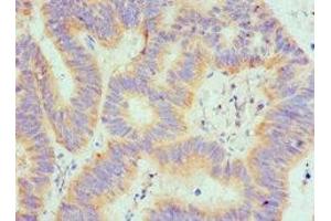 Immunohistochemistry of paraffin-embedded human colon cancer using ABIN7168895 at dilution of 1:100