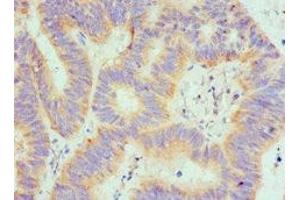 Immunohistochemistry of paraffin-embedded human colon cancer using ABIN7168895 at dilution of 1:100 (SPTLC1 anticorps  (AA 37-310))