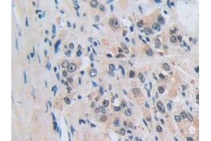 Detection of NUP50 in Human Prostate cancer Tissue using Polyclonal Antibody to Nucleoporin 50 kDa (NUP50)