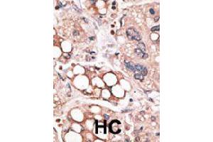 Formalin-fixed and paraffin-embedded human hepatocellular carcinoma tissue reacted with FOXO4 polyclonal antibody  , which was peroxidase-conjugated to the secondary antibody, followed by AEC staining. (FOXO4 anticorps  (N-Term))