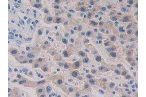 DAB staining on IHC-P; Samples: Human Liver cancer Tissue